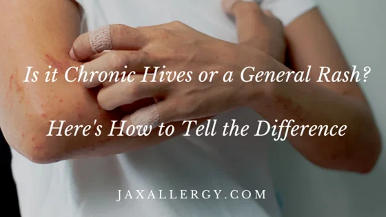 chronic hives (1)