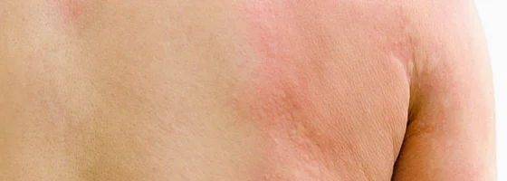 pink and white welts from hives on back 