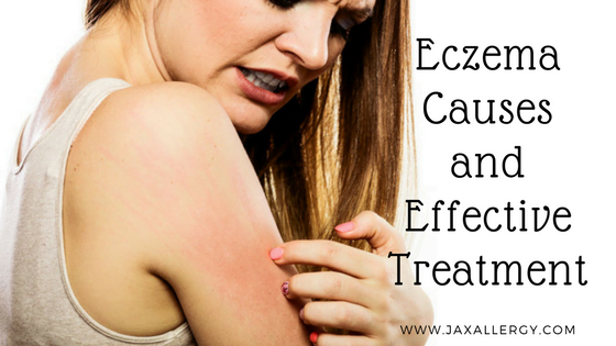 What Exactly Is Eczema and How Can it be Treated Effectively